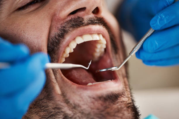Best Emergency Tooth Extraction in East Palo Alto, CA